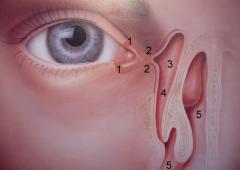 Obr. 1 Slzné cesty: 1 – slzné body, 2 – slzné kanálky, 3 – slzný vak, 4 – slzovod, 5 – dutina nosní.
