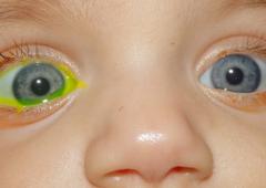 Obr. 2  Pravé oko dítěte FDT 2 – slzné cesty nedrénují, levé oko FDT 0 – normální drenáž.