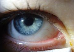 Obr. 5 Monokanyla dolního kanálku pravého oka.